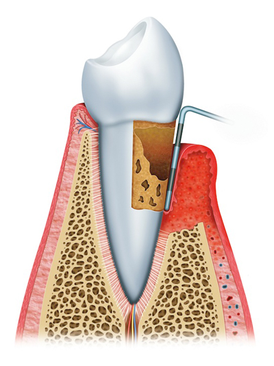 Stages of Gum Disease London, ON