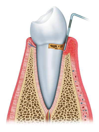 Stages of Gum Disease London, ON