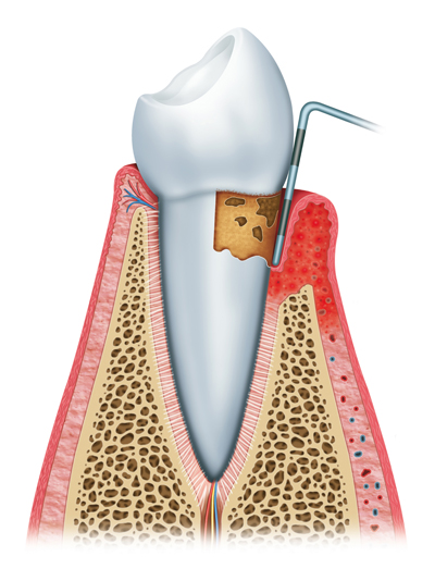 Stages of Gum Disease London, ON